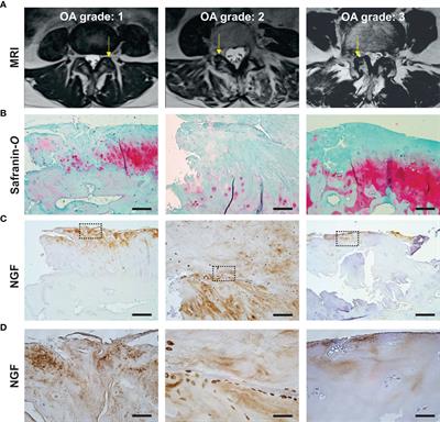 Localization of Nerve Growth Factor Expression to Structurally Damaged Cartilaginous Tissues in Human Lumbar Facet Joint Osteoarthritis